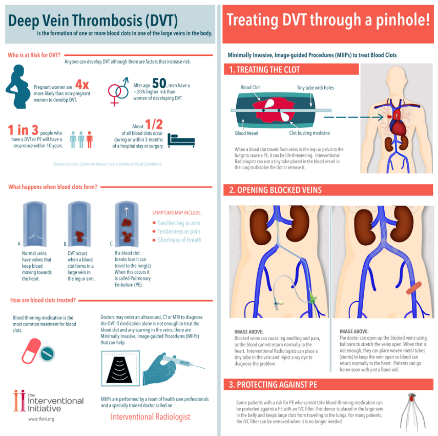 Treatment for Deep Vein Thrombosis in Denver, CO | MIPS Vein Center