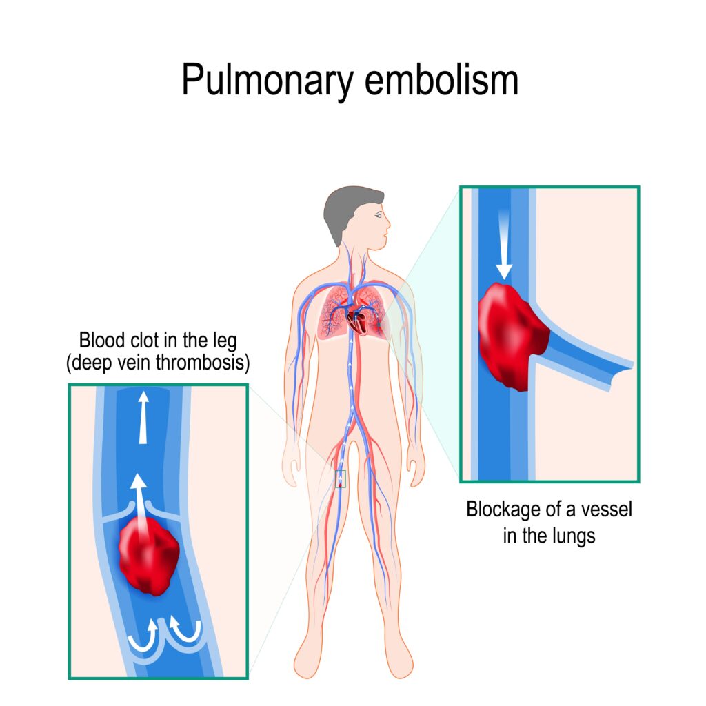 what is the clinical presentation of a pulmonary embolism