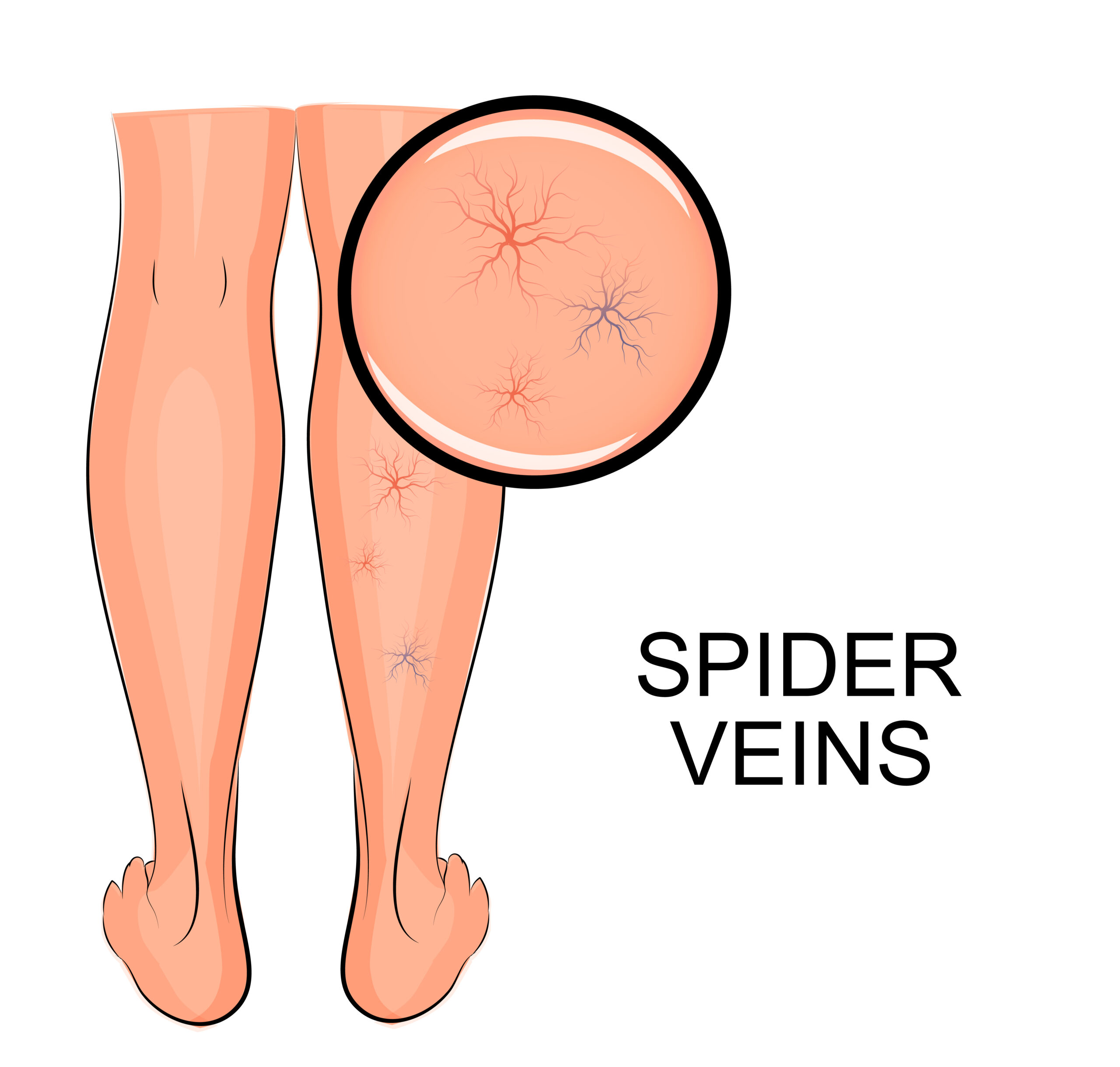 spider veins graphic