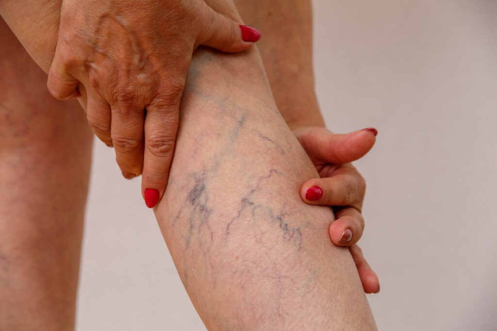Spider veins on a ladies leg.